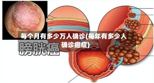 每个月有多少万人确诊(每年有多少人确诊癌症)