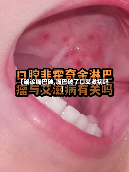 【确诊嘴巴破,嘴巴破了口艾滋病吗】