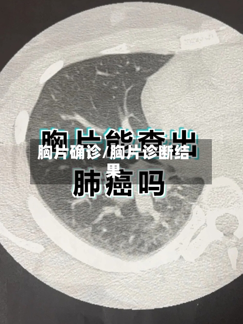 胸片确诊/胸片诊断结果
