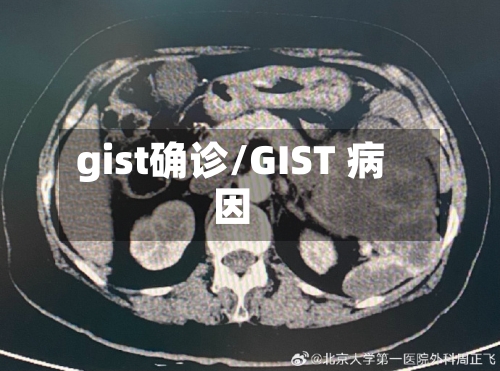 gist确诊/GIST 病因-第3张图片