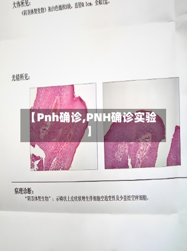 【Pnh确诊,PNH确诊实验】